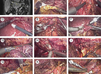 腹腔镜复杂肝胆管结石手术