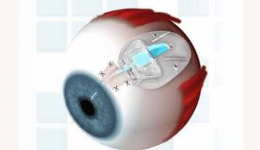 青光眼引流阀植入术、先天性青光眼360°小梁切开术、青光眼睫状体激光光凝术等