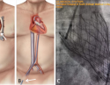 图1. 经导管主动脉瓣置换术（TAVR），A.常规开胸换瓣手术，B.TAVR手术，C.TAVR换瓣成功，箭头示手术切口