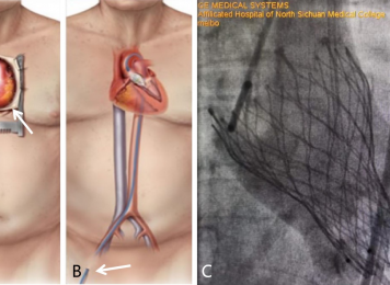 图1. 经导管主动脉瓣置换术（TAVR），A.常规开胸换瓣手术，B.TAVR手术，C.TAVR换瓣成功，箭头示手术切口