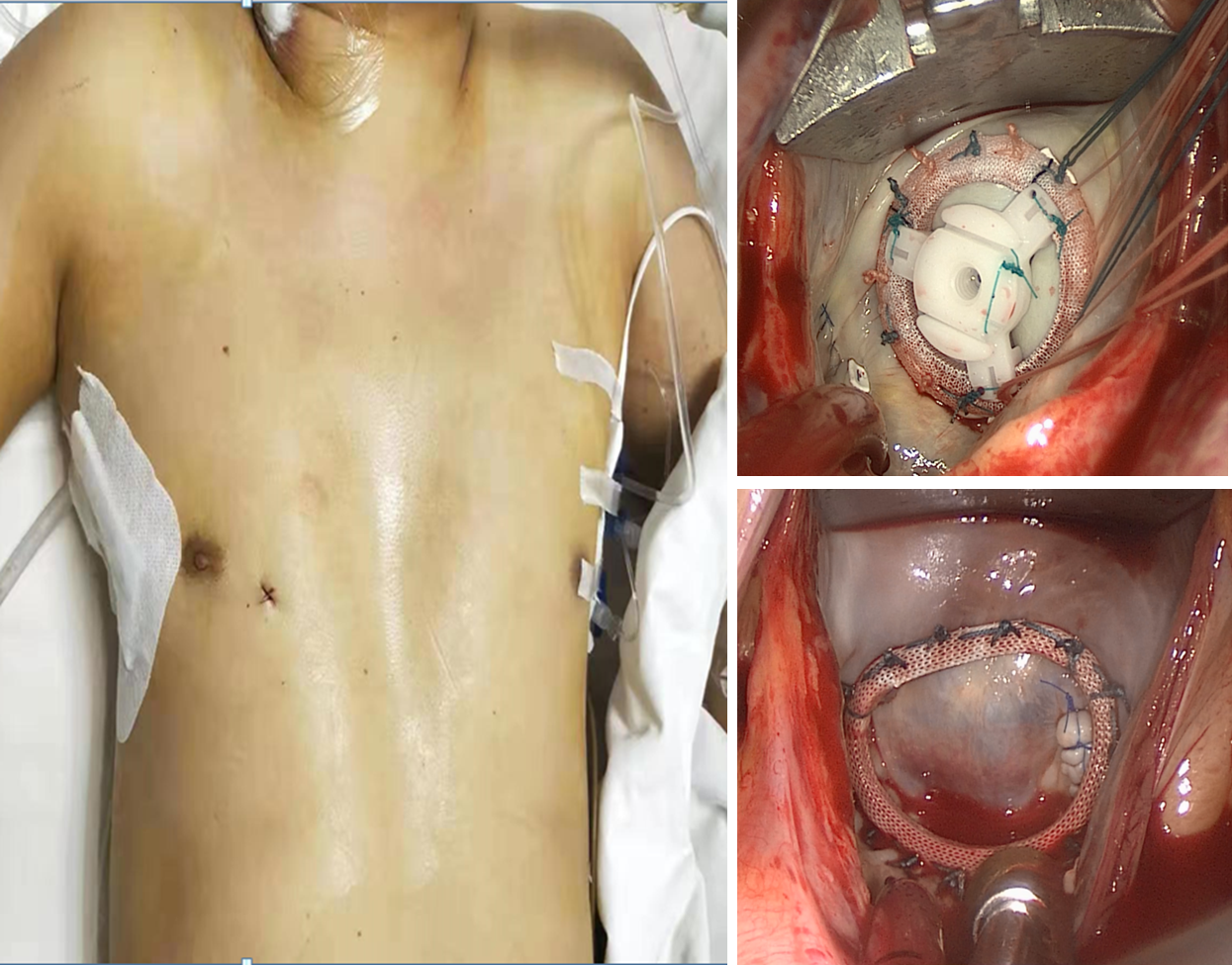 图2. 胸腔镜微创瓣膜修复术和置换术