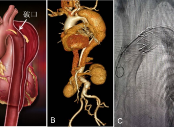 图5. B型主动脉夹层介入腔内分支覆膜支架植入术