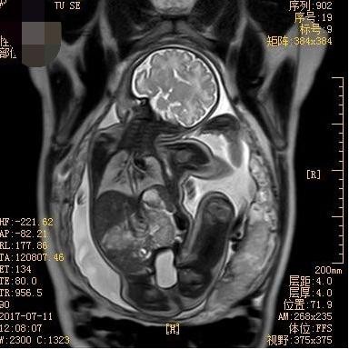 胎儿MRI