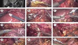 特色之六：腹腔镜复杂多次肝胆管结石肝部分切除术